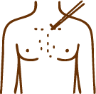 Body Hair Transplant