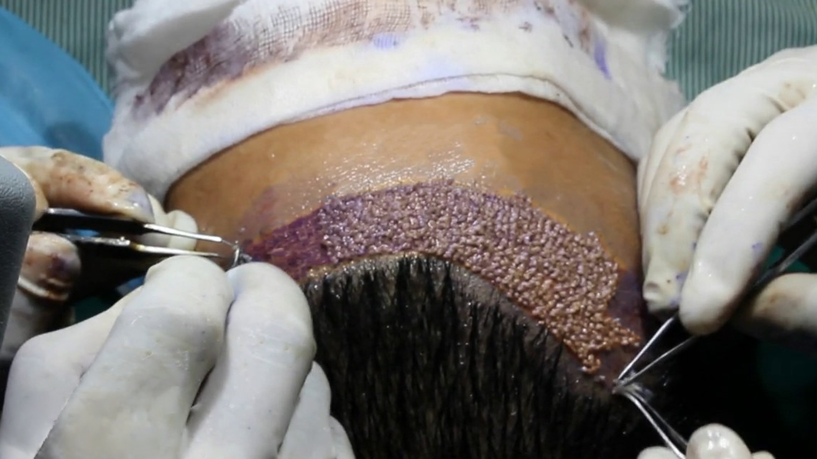 FUE Hair Transplant