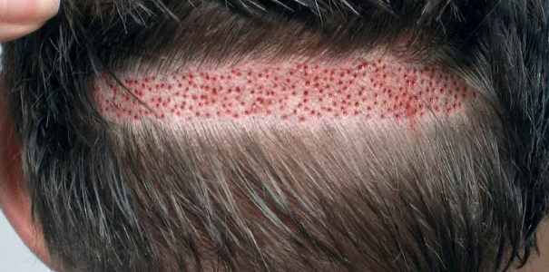 FUT Hair Transplant