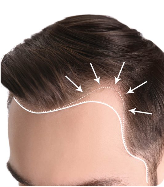 Common symptoms of hair loss in men including receding hairline and crown thinning