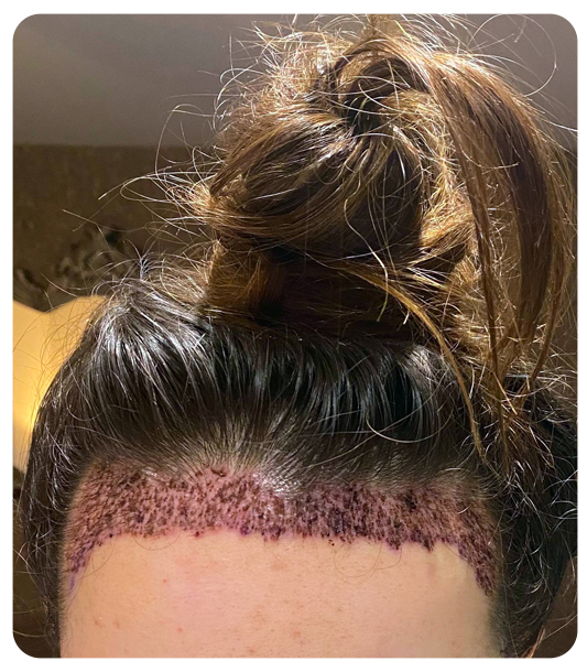 Celebrity hair transplant result at AK Clinics