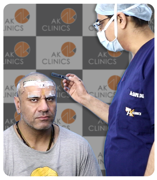 Celebrity hair transplant result at AK Clinics