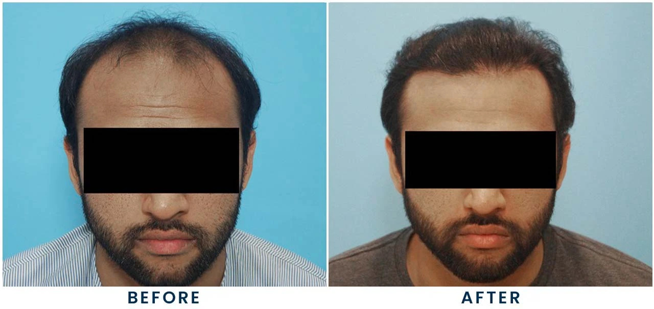 Patient result 1 – front view