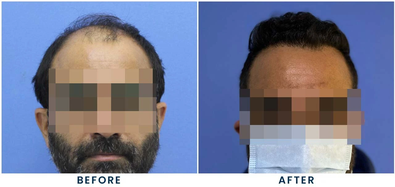 Patient result 2 – front view