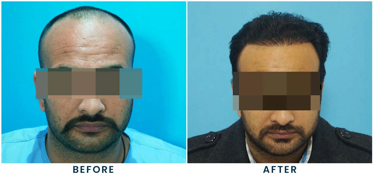 Patient result 3 – front view