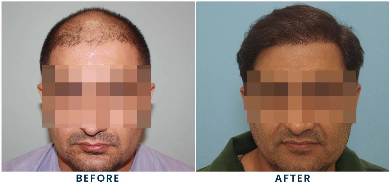 Patient result 6 – front view