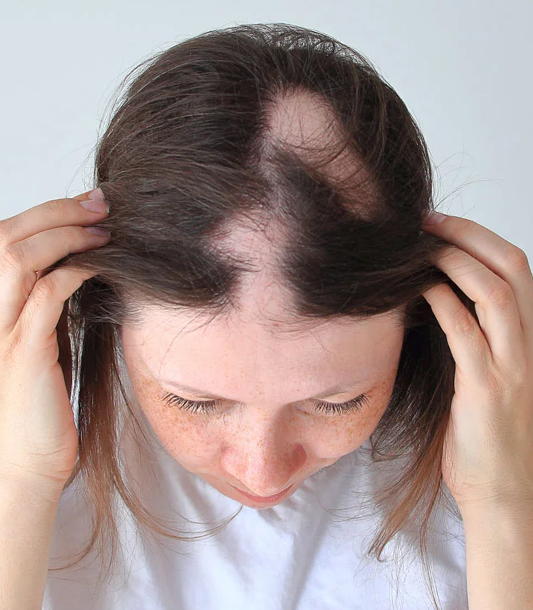 Stages of androgenetic alopecia and progression of pattern hair loss