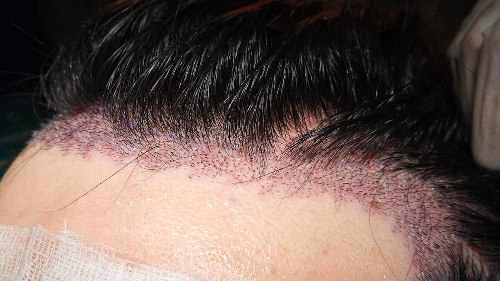 Unshaven FUE Hair Transplant