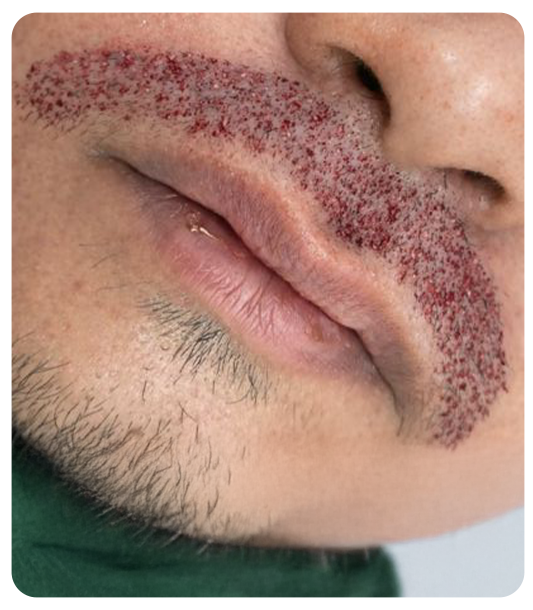Moustache hair transplant cost in India