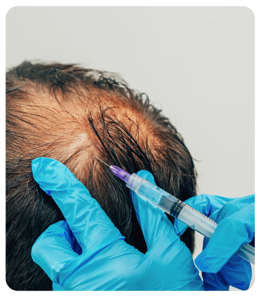 PRP hair treatment results