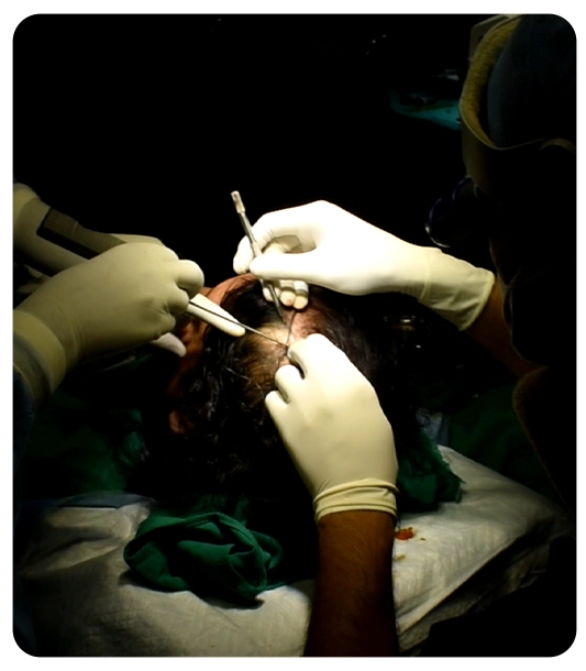 How to choose the right hair transplant clinic in Delhi