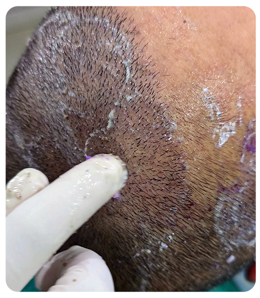 How IHT ensures safety and recovery during hair transplant