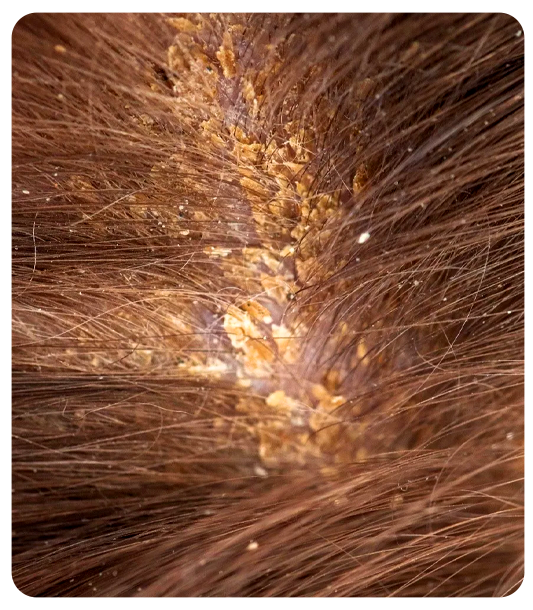 Common symptoms of seborrheic dermatitis including greasy flakes and scalp redness