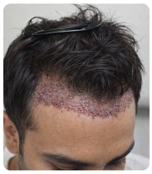 Benefits of unshaven FUE hair transplant
