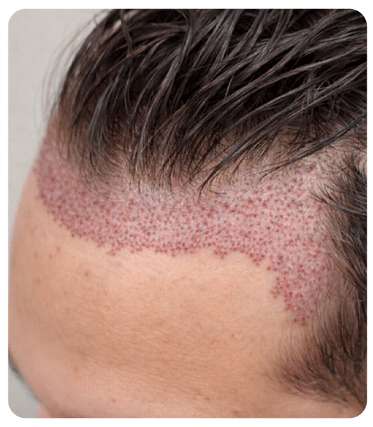 Unshaven FUE hair transplant cost