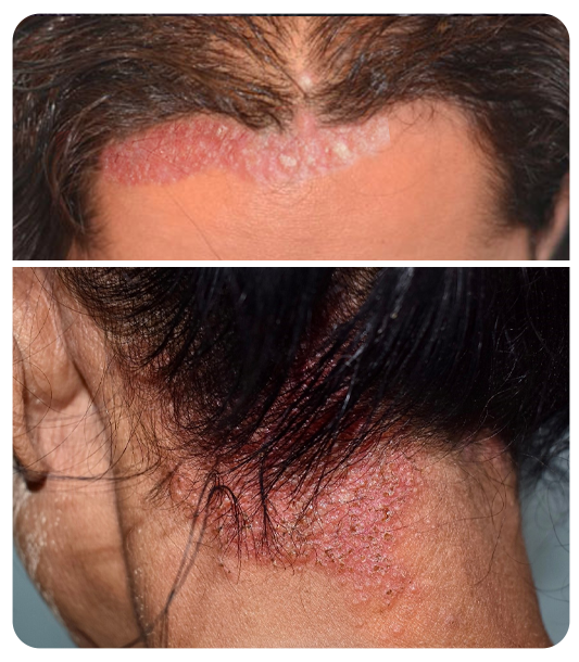 People more likely to develop seborrheic dermatitis such as those with oily skin and high stress